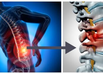 الانزلاق الغضروفي