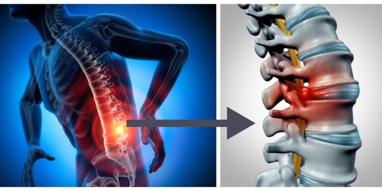 الانزلاق الغضروفي.. أسباب الإصابة والأعراض الشائعة وأبرز المحاذير 1 الانزلاق الغضروفي