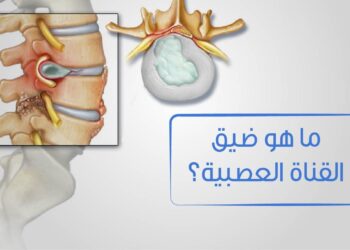 ضيق "القناة العصبية" و"شرايين القدمين".. الأعراض وأوجه الاختلاف والعلاج