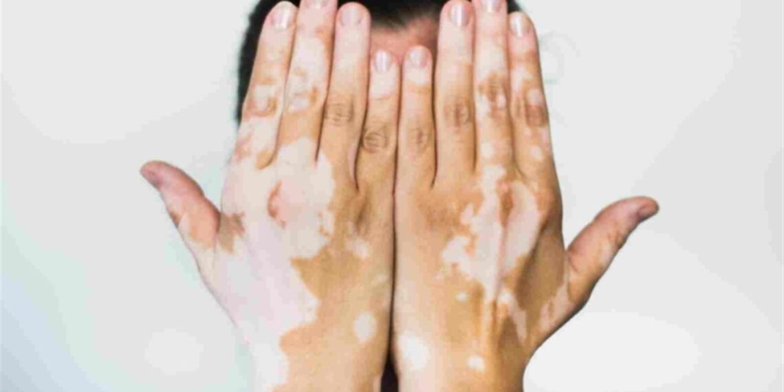 علاج البهاق بالأعشاب