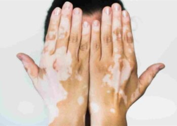 علاج البهاق بالأعشاب