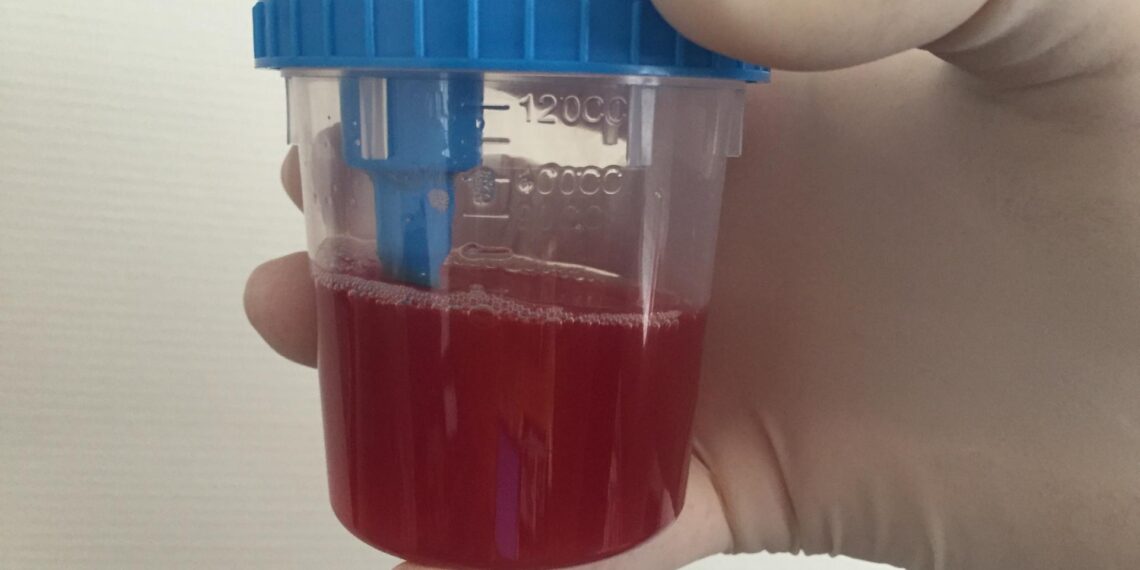 البول المدمم "الزائف".. 11 سببًا لهذه الظاهرة وأبرز النصائح الطبية 1 البول المدمم