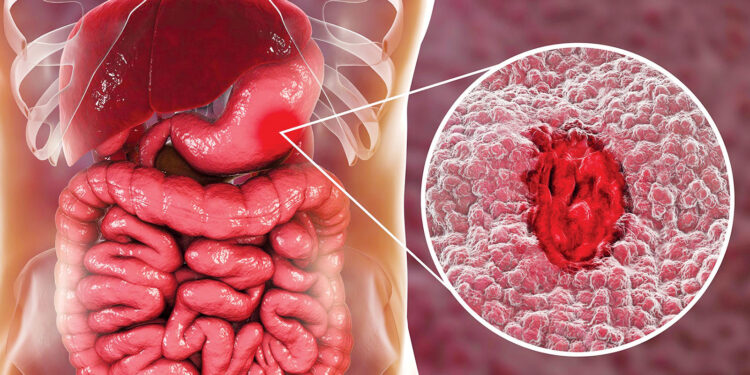جرثومة المعدة