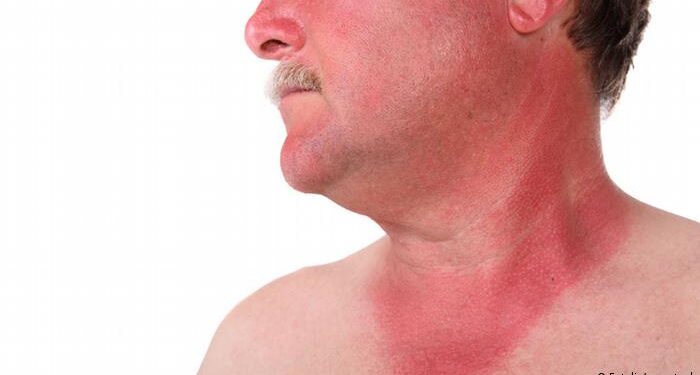 حروق الجلد وتصبغ البشرة في الصيف وعلاجها طبيعيًا 1 حروق الجلد