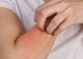 حساسية الجلد