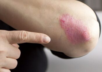 الإكزيما العصبية