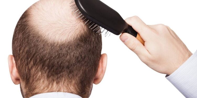 الصلع عند الرجال والسيدات.. مُسبباته وأفضل طُرق العلاج المُتاحة 1 الصلع