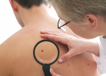 الميلانوما