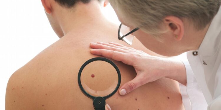 الميلانوما والوحمات المُلونة.. مخاطرها الصحية وطُرق العلاج المُتاحة 1 الميلانوما