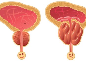 تضخم البروستاتا
