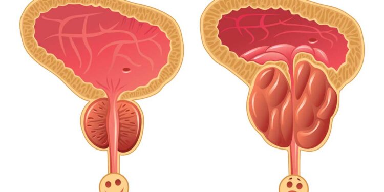 تضخم البروستاتا.. الأعراض الجانبية وطريقة العلاج الصحيحة 1 تضخم البروستاتا