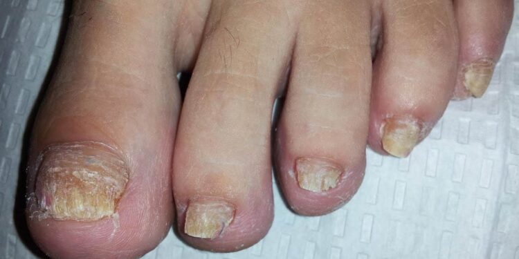 فطريات الأظافر وتقرحات الجلد.. علاقتها بـ"القدم السكري" وأبرز طرق العلاج المُتاحة 1 فطريات الأظافر