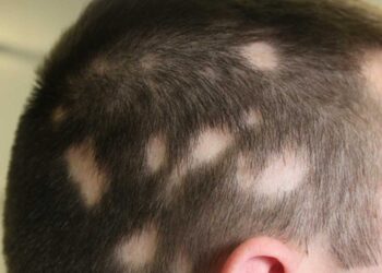 مرض الثعلبة